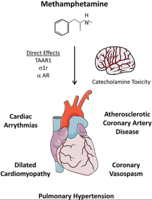 An image representing the negative effects of methamphetamine on cardiovascular health through direct effects and catecholamine toxicity—How does meth addiction affect health? by Ardu Recovery Center